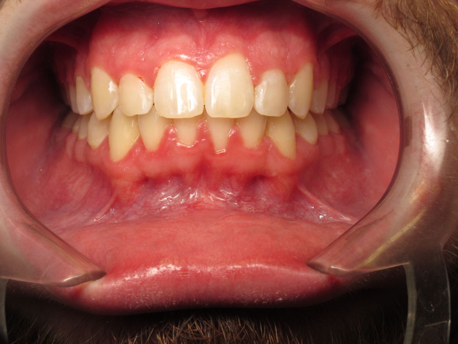 Before & After Harrisonville, MO Custom Dental of Harrisonville